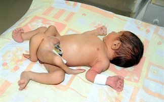 ΑΠΙΣΤΕΥΤΟ: Μωρό με έξι πόδια γεννήθηκε στο Πακιστάν! - Φωτογραφία 1
