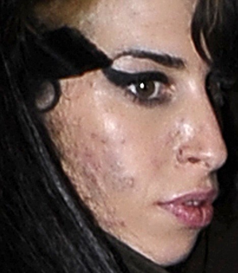 ΣΟΚΑΡΙΣΤΙΚΕΣ ΕΙΚΟΝΕΣ: H Amy Winehouse υπέφερε από βακτηριακή μόλυνση - Φωτογραφία 3