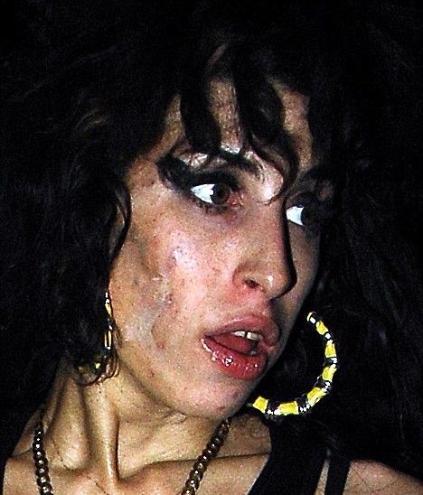 ΣΟΚΑΡΙΣΤΙΚΕΣ ΕΙΚΟΝΕΣ: H Amy Winehouse υπέφερε από βακτηριακή μόλυνση - Φωτογραφία 4