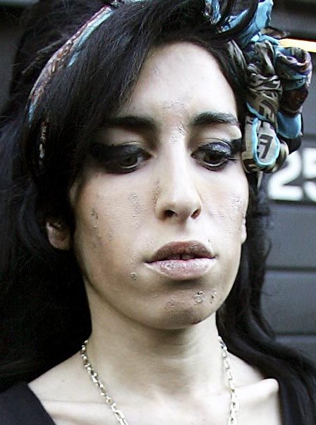 ΣΟΚΑΡΙΣΤΙΚΕΣ ΕΙΚΟΝΕΣ: H Amy Winehouse υπέφερε από βακτηριακή μόλυνση - Φωτογραφία 6