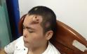 Chinese doctor builds new nose on man's forehead