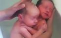 Συγκλονιστικό βίντεο: Διδυμάκια γεννήθηκαν και παραμένουν αγκαλιασμένα