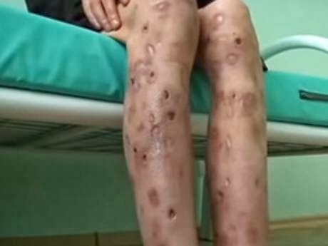 Το ναρκωτικό Krokodil που τρώει τη σάρκα έχει τρομοκρατήσει τις ΗΠΑ - ΠΡΟΣΟΧΗ! Σκληρές εικόνες - Φωτογραφία 3