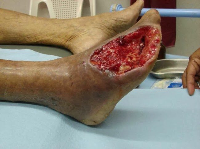 Το ναρκωτικό Krokodil που τρώει τη σάρκα έχει τρομοκρατήσει τις ΗΠΑ - ΠΡΟΣΟΧΗ! Σκληρές εικόνες - Φωτογραφία 6