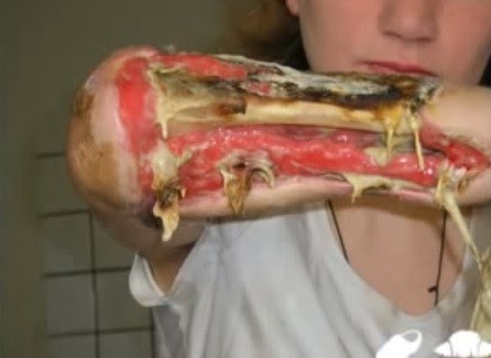 Το ναρκωτικό Krokodil που τρώει τη σάρκα έχει τρομοκρατήσει τις ΗΠΑ - ΠΡΟΣΟΧΗ! Σκληρές εικόνες - Φωτογραφία 7