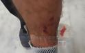 Στο νοσοκομείο από επίθεση σκύλων στην Πρέβεζα στο Μονολίθι - Φωτογραφία 2