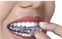Απώλεια δοντιού, αιτία, συνέπειες, πρόληψη, αντιμετώπιση. Πώς και γιατί χάνεται ένα δόντι; - Φωτογραφία 3