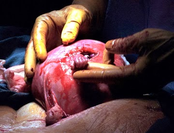 Συγκλονιστικές εικόνες ρουμάνου φωτογράφου από εκτρώσεις - προσοχή σκληρές εικόνες - Φωτογραφία 11