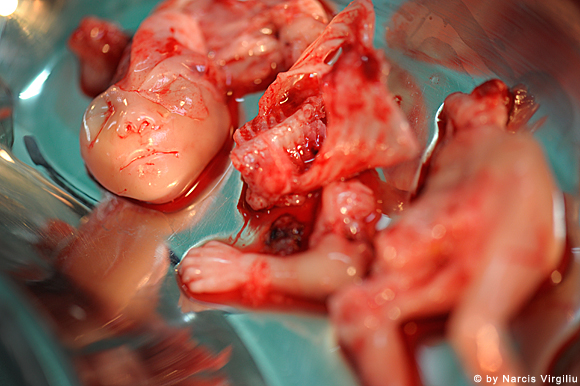 Συγκλονιστικές εικόνες ρουμάνου φωτογράφου από εκτρώσεις - προσοχή σκληρές εικόνες - Φωτογραφία 8