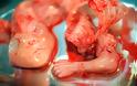 Συγκλονιστικές εικόνες ρουμάνου φωτογράφου από εκτρώσεις - προσοχή σκληρές εικόνες - Φωτογραφία 4