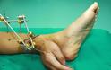 Σοκάρει η ιστορία ενός Κινέζου που είχε κομμένο χέρι ενωμένο με τον αστράγαλό του μετά από εργατικό ατύχημα - Φωτογραφία 2