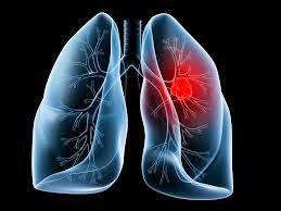 Ο καρκίνος του πνεύμονα συχνά δεν παρουσιάζει συμπτώματα παρά μόνο αφού φτάσει σε προχωρημένο στάδιο. Η έγκαιρη διάγνωση σώζει ζωές - Φωτογραφία 1