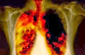 Ο καρκίνος του πνεύμονα συχνά δεν παρουσιάζει συμπτώματα παρά μόνο αφού φτάσει σε προχωρημένο στάδιο. Η έγκαιρη διάγνωση σώζει ζωές - Φωτογραφία 3