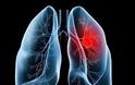 Ο καρκίνος του πνεύμονα συχνά δεν παρουσιάζει συμπτώματα παρά μόνο αφού φτάσει σε προχωρημένο στάδιο. Η έγκαιρη διάγνωση σώζει ζωές - Φωτογραφία 1