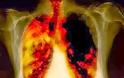 Ο καρκίνος του πνεύμονα συχνά δεν παρουσιάζει συμπτώματα παρά μόνο αφού φτάσει σε προχωρημένο στάδιο. Η έγκαιρη διάγνωση σώζει ζωές - Φωτογραφία 3