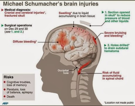 Διάγραμμα με τις κρανιοεγκεφαλικές κακώσεις που έχει υποστεί ο Σουμάχερ [photo] - Φωτογραφία 2