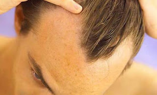 Αισιόδοξη έρευνα για τις θεραπείες αναπαραγωγής μαλλιών - Φωτογραφία 1