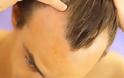 Αισιόδοξη έρευνα για τις θεραπείες αναπαραγωγής μαλλιών