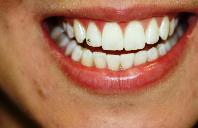 Όσα θέλετε να μάθετε για τη Λεύκανση των δοντιών - Φωτογραφία 1