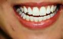 Όσα θέλετε να μάθετε για τη Λεύκανση των δοντιών - Φωτογραφία 1