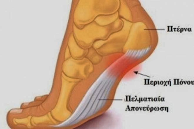 Πόνος στη φτέρνα, πελματιαία απονεύρωση, άκανθα πτέρνας. Θεραπευτική αντιμετώπιση και ασκήσεις για το σπίτι - Φωτογραφία 2