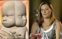 Κυοφορεί μωρό με δύο πρόσωπα και δύο εγκεφάλους [video]