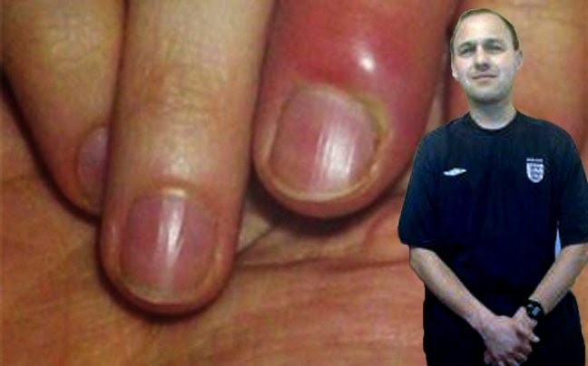 Πέθανε επειδή έτρωγε τα νύχια του! - Φωτογραφία 2