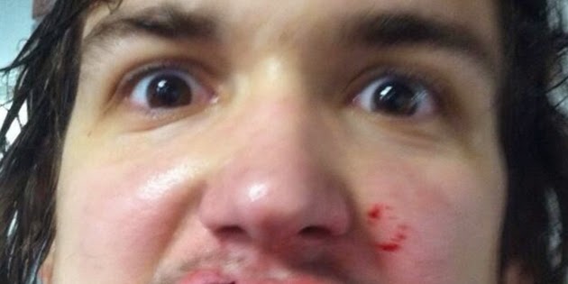 Παίκτης του Χόκεϊ σοκάρει με τις τρομακτικές φωτογραφίες που ανέβασε στα social media, μετά το φρικτό ατύχημά του στο γήπεδο - Φωτογραφία 2