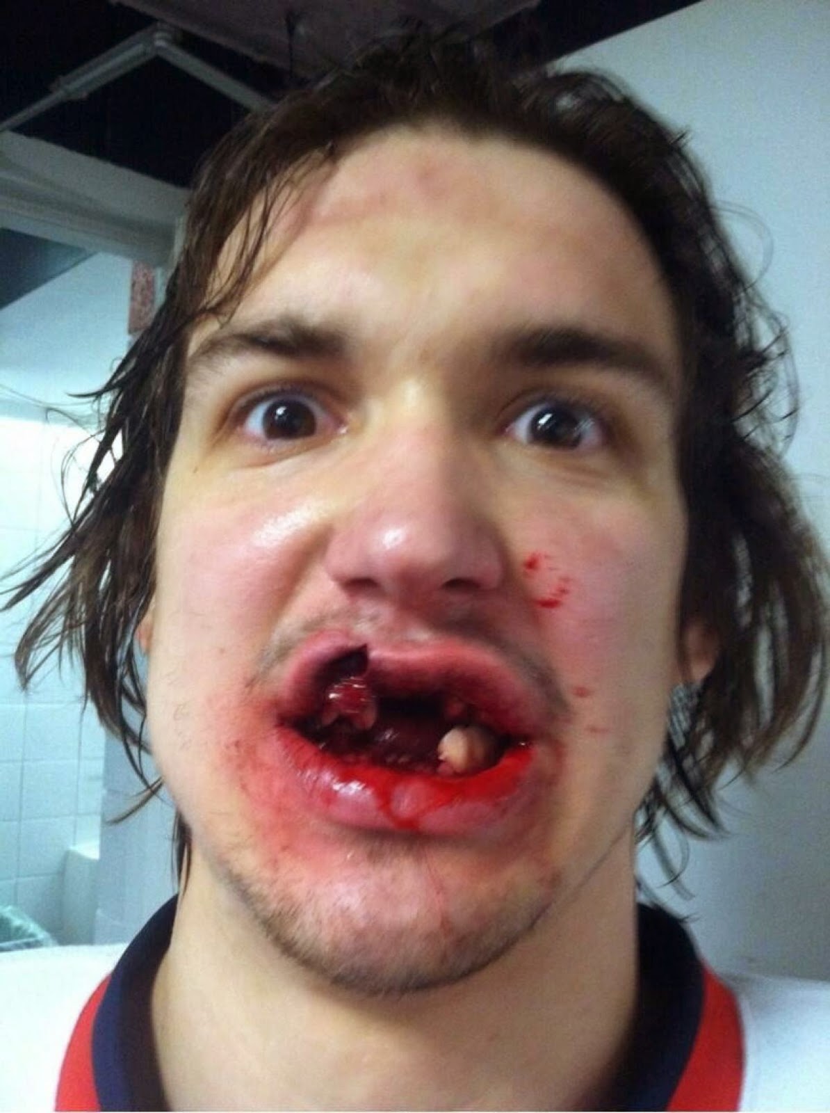 Παίκτης του Χόκεϊ σοκάρει με τις τρομακτικές φωτογραφίες που ανέβασε στα social media, μετά το φρικτό ατύχημά του στο γήπεδο - Φωτογραφία 4