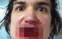 Παίκτης του Χόκεϊ σοκάρει με τις τρομακτικές φωτογραφίες που ανέβασε στα social media, μετά το φρικτό ατύχημά του στο γήπεδο - Φωτογραφία 3