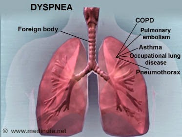Ποιες είναι οι αιτίες που προκαλείται η δύσπνοια - Φωτογραφία 2