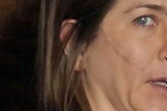 Τι συνέβη στην Τζένιφερ Άνιστον; - Εμφανίστηκε με βαθιές χαρακιές και ράμματα στο πρόσωπο