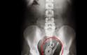 ΔΕΝ ΘΑ ΠΙΣΤΕΥΕΤΕ ΣΤΑ ΜΑΤΙΑ ΣΑΣ....Δείτε τι αφαιρούν από το στομάχι ασθενών χειρουργοί! -ΦΩΤΟ - Φωτογραφία 1