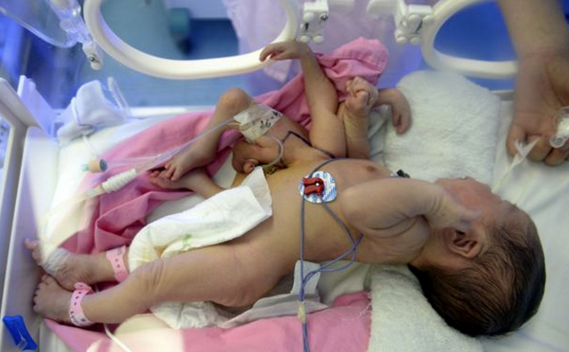 Εικόνες που σοκάρουν: Μωρό γεννήθηκε με 8 άκρα [photo] - Φωτογραφία 2