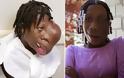 Σοκ: Κοριτσάκι 15 ετών με τεράστιο όγκο 2 κιλών στο πρόσωπο του - Ξεκίνησε σαν ένα μικρό μπιζέλι στη μύτη του [video] - Φωτογραφία 2
