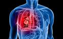 Προσοχή: Απλά σημάδια που δείχνουν καρκίνο του πνεύμονα