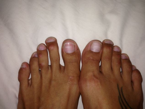 Η «πλαστική της Σταχτοπούτας» γίνεται μόδα: Γυναίκες κόβουν τα δάχτυλα των ποδιών τους για να φορούν πέδιλα [photos]] - Φωτογραφία 2