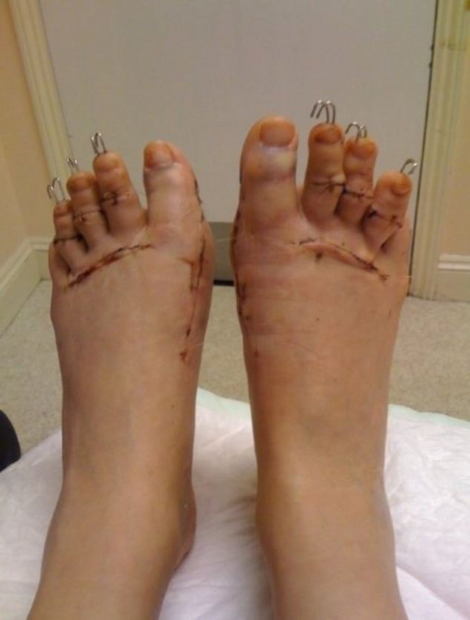 Η «πλαστική της Σταχτοπούτας» γίνεται μόδα: Γυναίκες κόβουν τα δάχτυλα των ποδιών τους για να φορούν πέδιλα [photos]] - Φωτογραφία 5