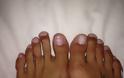 Η «πλαστική της Σταχτοπούτας» γίνεται μόδα: Γυναίκες κόβουν τα δάχτυλα των ποδιών τους για να φορούν πέδιλα [photos]] - Φωτογραφία 2