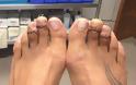 Η «πλαστική της Σταχτοπούτας» γίνεται μόδα: Γυναίκες κόβουν τα δάχτυλα των ποδιών τους για να φορούν πέδιλα [photos]] - Φωτογραφία 3