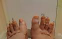 Η «πλαστική της Σταχτοπούτας» γίνεται μόδα: Γυναίκες κόβουν τα δάχτυλα των ποδιών τους για να φορούν πέδιλα [photos]] - Φωτογραφία 5