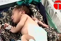 ΔΕΙΤΕ: Μωρό γεννήθηκε με τρία χέρια