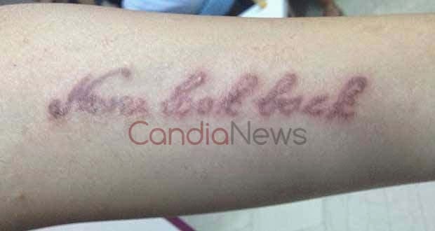 Δείτε τι έπαθε 12χρονη από τατουάζ χένας - Φωτογραφία 2