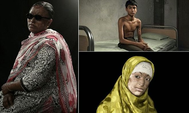 Συγκλονιστικό: Οι άνθρωποι που γλύτωσαν από επιθέσεις με οξύ [photos] - Φωτογραφία 1