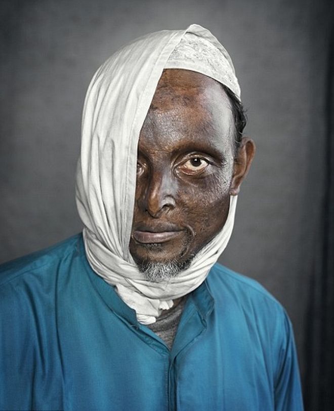 Συγκλονιστικό: Οι άνθρωποι που γλύτωσαν από επιθέσεις με οξύ [photos] - Φωτογραφία 3