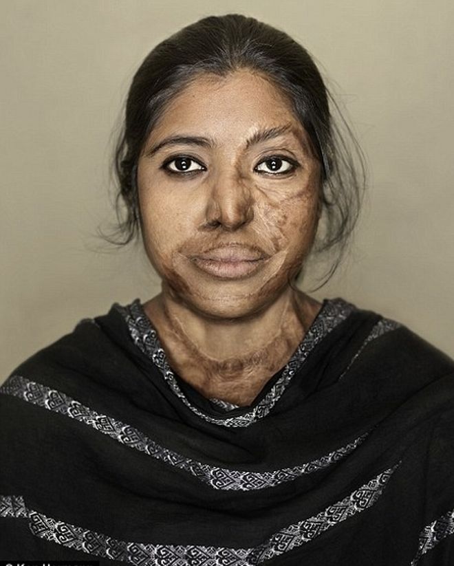 Συγκλονιστικό: Οι άνθρωποι που γλύτωσαν από επιθέσεις με οξύ [photos] - Φωτογραφία 5