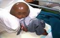 ΣΟΚ: Δείτε τις εικόνες του παιδιού που γεννήθηκε με το μεγαλύτερο κεφάλι... [photo] - Φωτογραφία 5