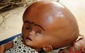 ΣΟΚ: Δείτε τις εικόνες του παιδιού που γεννήθηκε με το μεγαλύτερο κεφάλι... [photo] - Φωτογραφία 6