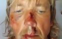 Άγγλος ποδηλάτης τραυματίστηκε στη Σκιάθο  - Ο εφιάλτης του τουρίστα και η επιστολή του!