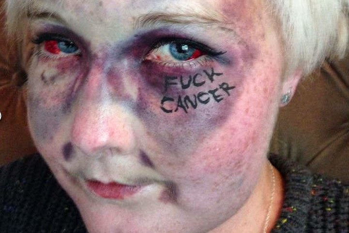 Βρετανία: Οι σοκαριστικές selfies – μήνυμα εναντίον του καρκίνου! [photos] - Φωτογραφία 2